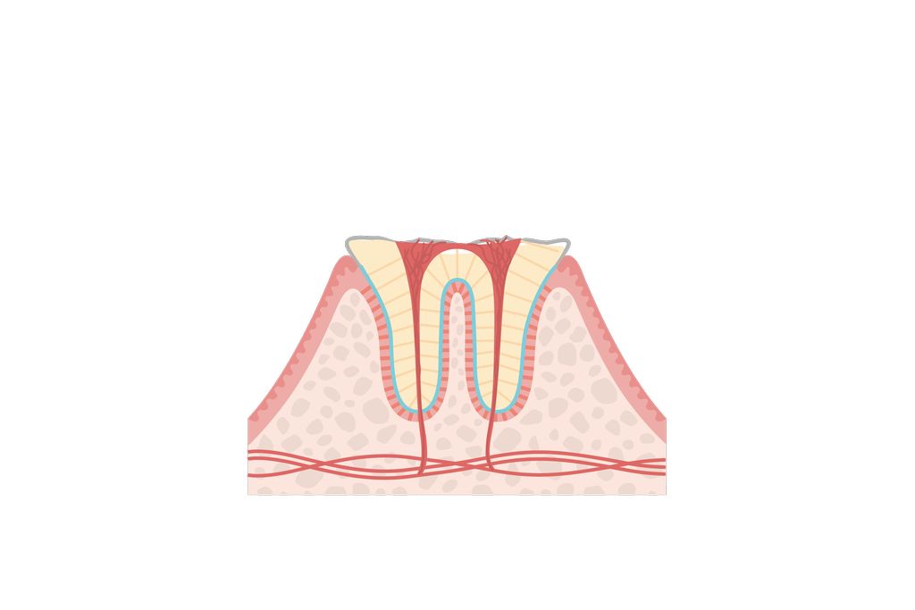 C4(歯根・保存不可)